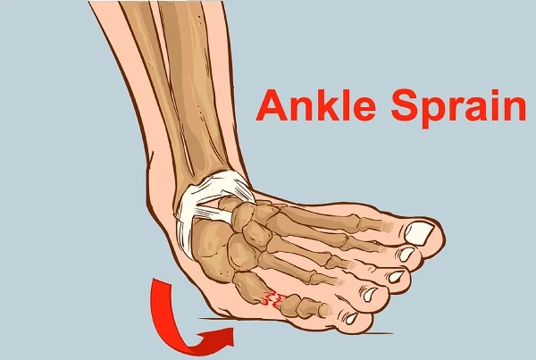 Ankle Sprain